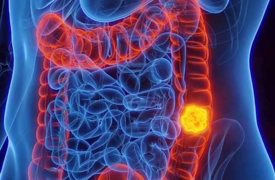 Câncer colorretal e metástases: sinais de alerta, rastreamento e quando a cirurgia pode curar