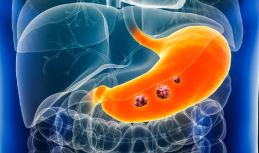 Câncer de estômago: sinais de alerta, diagnóstico e quando a cirurgia é indicada